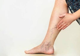 Varices: un problema con solución