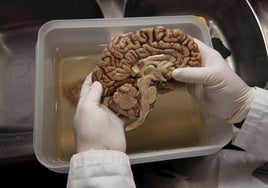 La Ciencia pide más donantes de cerebro para frenar el avance de las demencias
