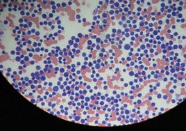Una innovadora terapia CAR-T española rescata a pacientes con linfoma
